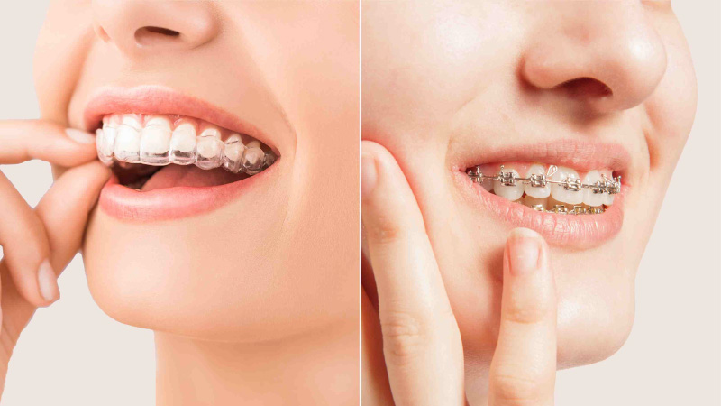 Orthodontic Treatments